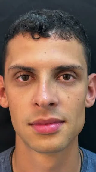 Antes da harmonização facial masculina