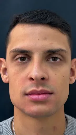 Depois da harmonização facial masculina