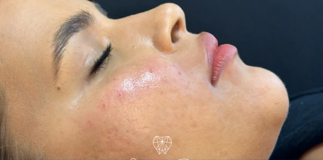 Antes do preenchimento labial, de perfil