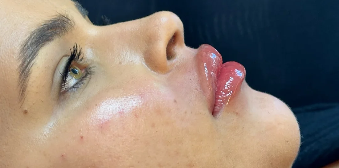 Depois do preenchimento labial, de perfil
