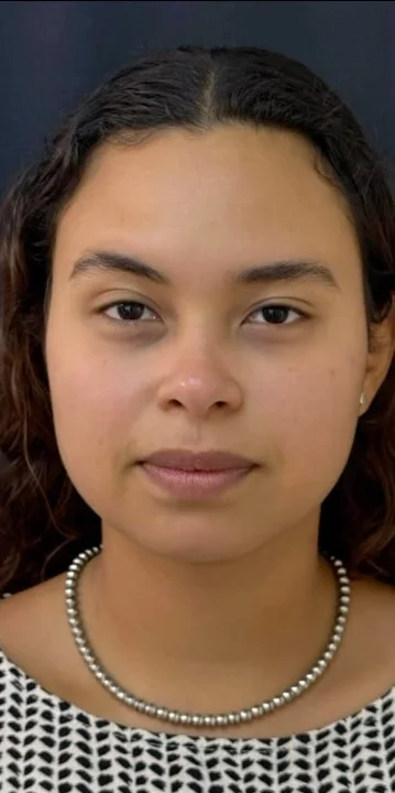 Depois da aplicação de toxina botulínica